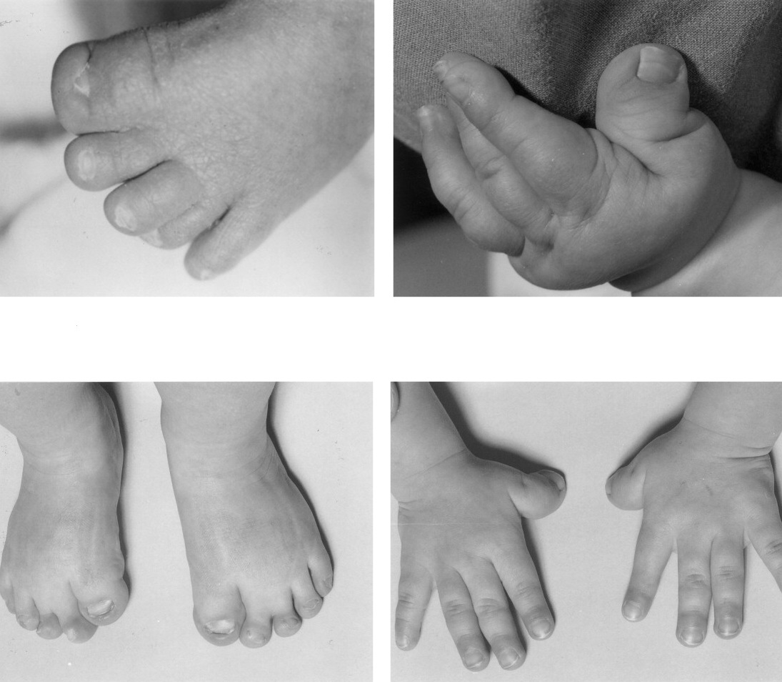 Musculoskeletal dysplasias in children are common. Lets present in your class using this amazing power point presentation on msk dysplasias